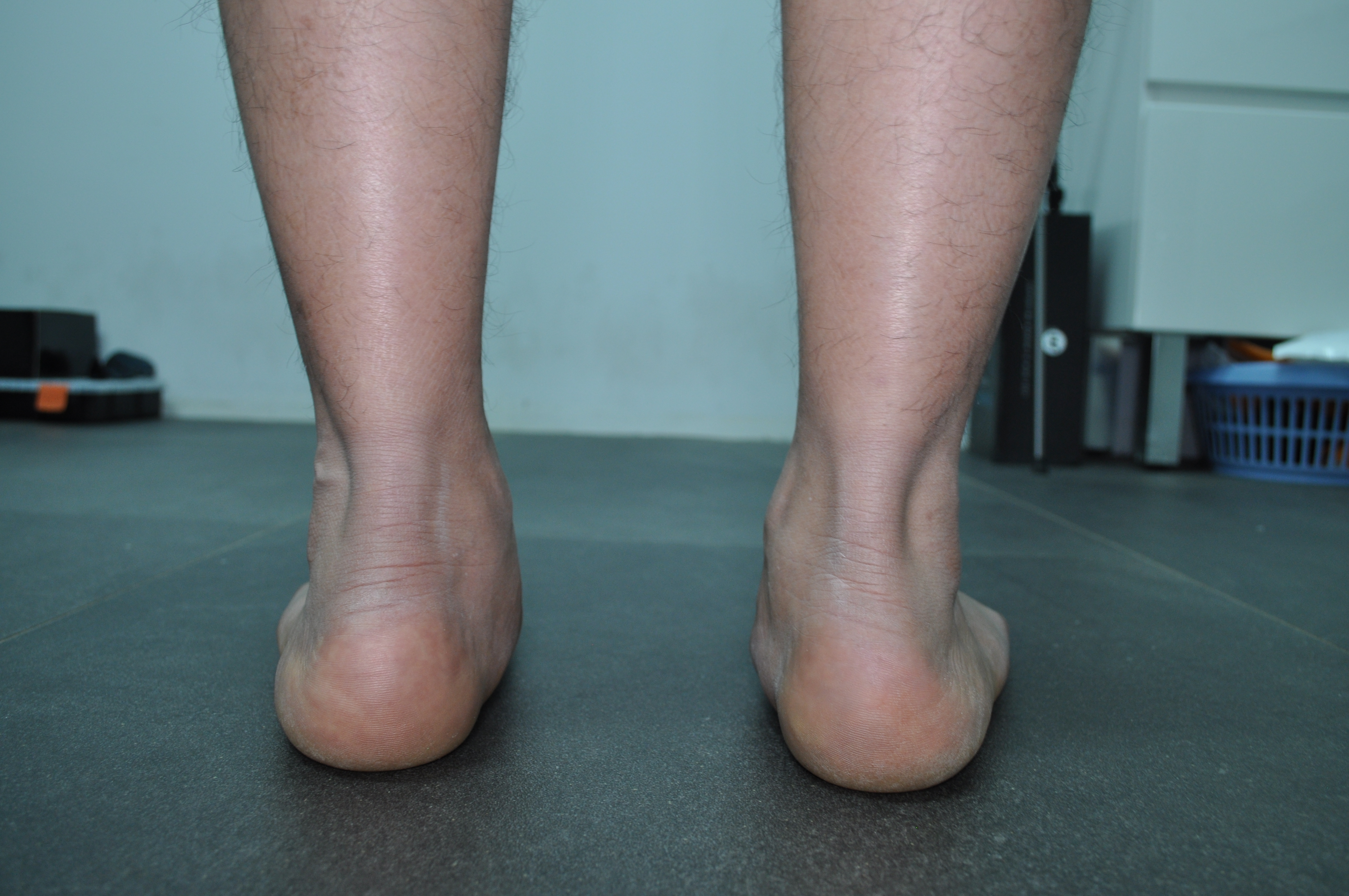 does having flat feet affect your balance
